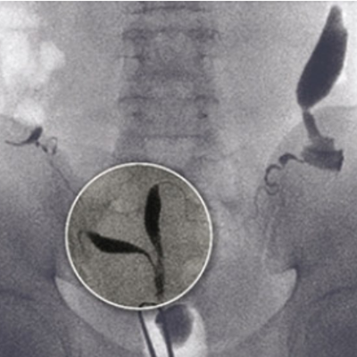 Lipiodol® HSG showing Müllerian duct anomalies