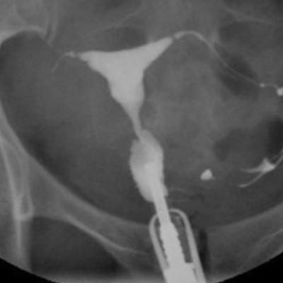 Lipiodol® HSG showing proximal occlusion of the right tube; normal uterine cavity & patent left tube