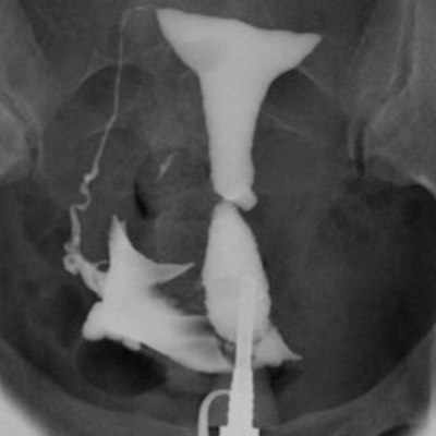 Lipiodol® HSG showing uterine cavity with a filling defect near the left tubal corner due to an endometrial polyp; normal right tube with patency