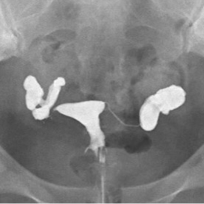  Lipiodol® HSG showing bilateral hydrosalpinges with distal occlusion