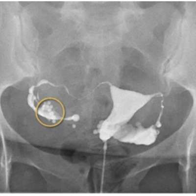 Lipiodol® HSG showing normal uterine cavity and patent tubes 