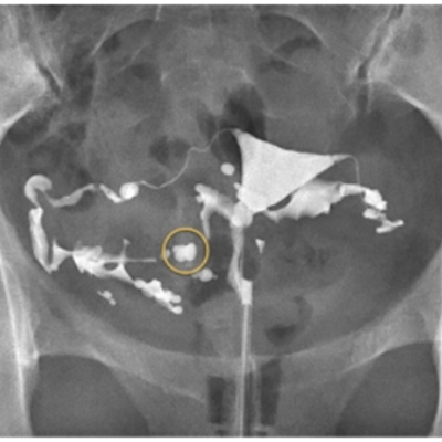 Lipiodol® HSG showing normal uterine cavity and patent tubes 